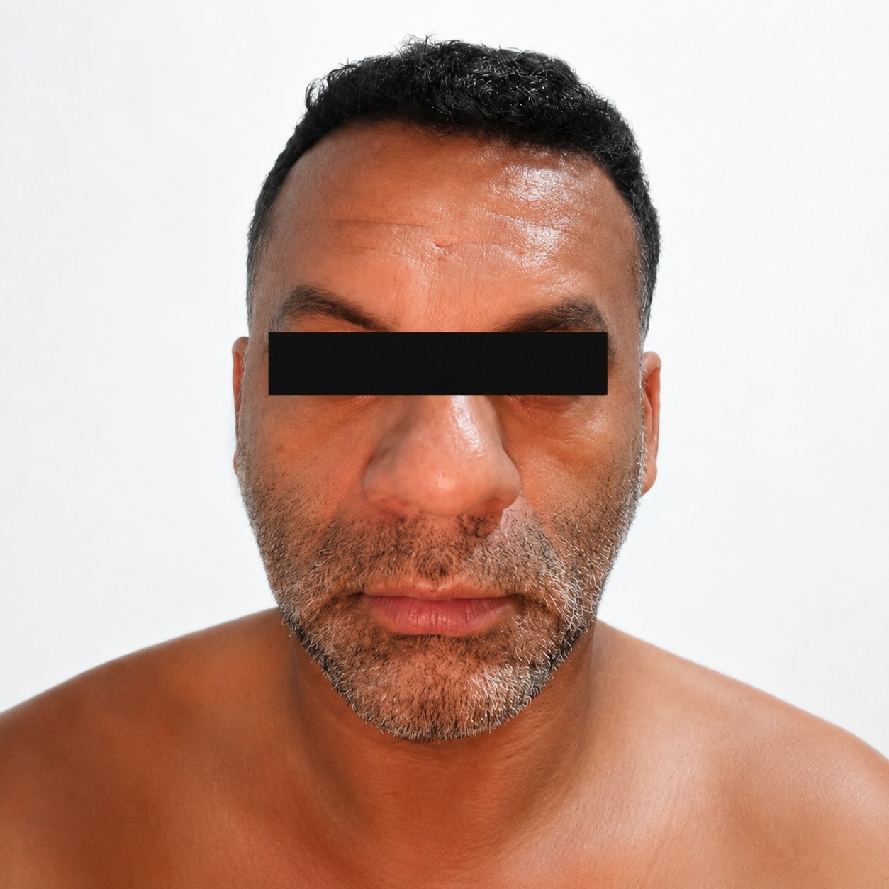 Antes de armonización facial